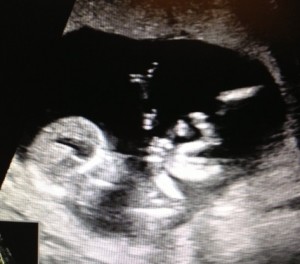13 week ultrasound